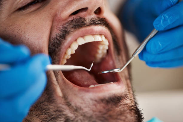Teeth Whitening in MS